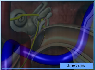 Sigmoid Sinus